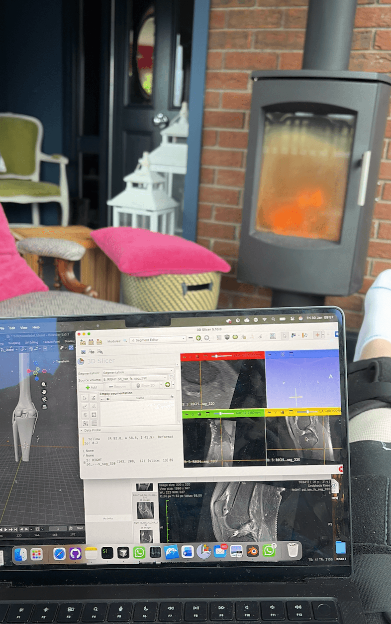 Laptop showing 3D knee model built from MRI scans